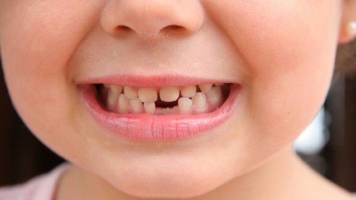 Traumi Dentari In Eta Infantile Quali Conseguenze Dentista Lecco